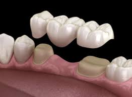 dental veneers in pragathi nagar